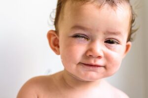 Remedios Caseros Para Ojos Legañosos En Bebés
